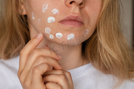 精华护肤品摄影照片_面目全非的女人在脸上化妆，用奶油精华液治疗痤疮。