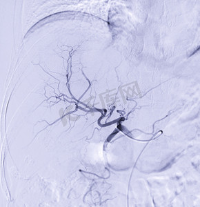 TACE 或化疗栓塞术的成像是一种允许将一定剂量的化疗药物直接施用于显示肝动脉的肝肿瘤或 HCC 的程序。
