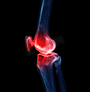 感染摄影照片_在显示疼痛区域的黑色背景上隔离的膝关节的 3d 渲染。
