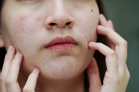 皮肤面部痤疮疙瘩和疤痕，皮脂腺疾病，少女护肤美容问题。