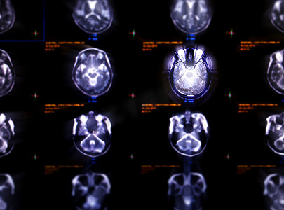 脑卒中卡通摄影照片_MRI 脑轴向视图的选择性聚焦，用于检测脑卒中疾病的各种情况。