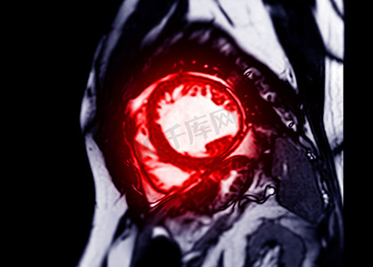 MRI 心脏或心脏 MRI 在短轴视图中显示用于诊断心脏病的左心室和右心室的横截面。
