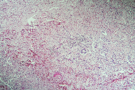 100x 显微镜下的肝癌病变组织