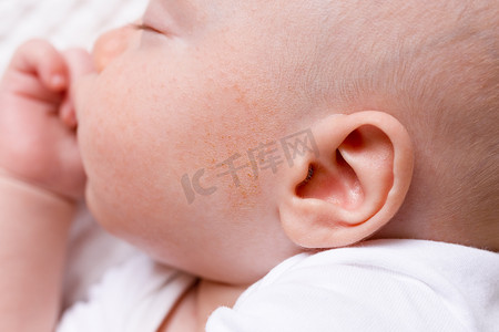 婴儿婴儿皮炎过敏性皮肤