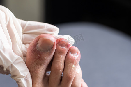 一个男人的脚趾显示出看起来像皮疹和红色斑点的皮肤。 