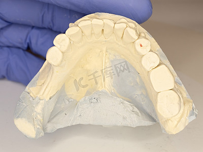 显示患者蛀牙的铸造模型