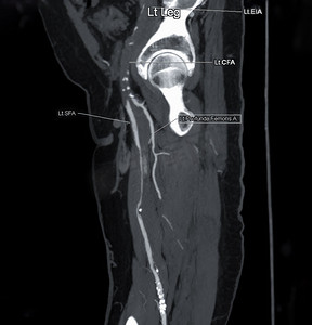 CTA 股动脉从 MPR 曲线上流出，显示左股动脉用于诊断急性或慢性外周动脉疾病。