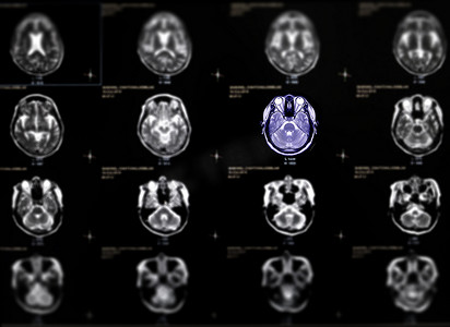 MRI 脑轴向视图的选择性聚焦，用于检测脑卒中疾病的各种情况。