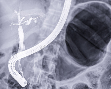 医生在现代手术室内进行 ERCP 和腹腔镜胆囊切除术后的内窥镜 X 射线图像。