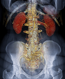 融合与摄影照片_CTA 腹主动脉 3D 渲染融合与 X 射线腹部图像。