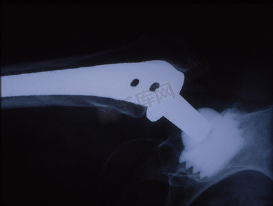 人体大腿 X 射线图像中的人工髋关节