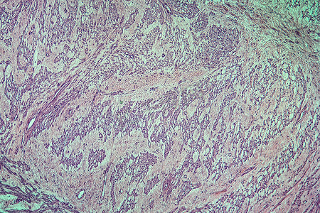 子宫肌瘤摄影照片_子宫病变组织的纤维肌瘤 100x
