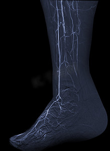 股动脉血管造影或下肢区域血管造影。