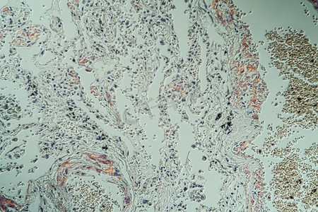 显微镜下有病态组织淀粉样蛋白沉积的肺