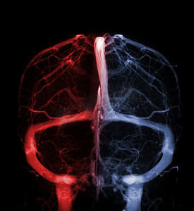 评估诊断摄影照片_用于诊断脑静脉血栓形成的脑静脉造影术