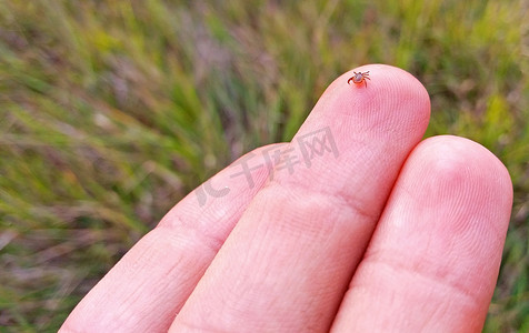 人类的皮肤摄影照片_人手上的小螨虫