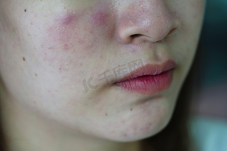 医学美容摄影照片_皮肤面部痤疮疙瘩和疤痕，皮脂腺疾病，少女护肤美容问题。