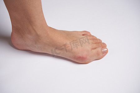 拇指外翻摄影照片_Hllux Valgus 在女性腿上关闭 solated 在白色背景上