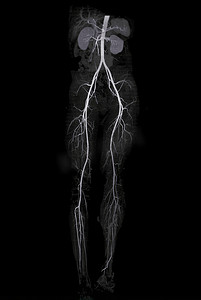 或股摄影照片_CTA 股动脉流出显示股动脉用于诊断急性或慢性外周动脉疾病。