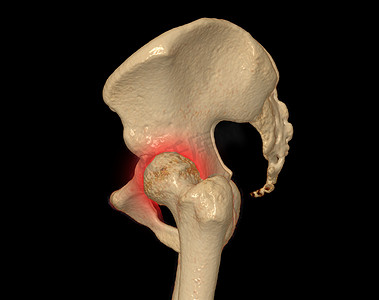骨盆骨和髋关节 3D 渲染的 CT 扫描，用于诊断黑色背景下骨盆骨和髋关节骨折。