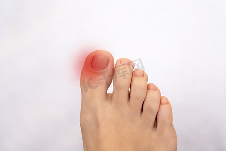 女性足部发炎，有红斑。