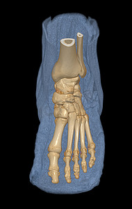 用于诊断骨折和类风湿性关节炎的脚骨 3D 渲染。