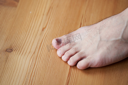 皮肤创伤摄影照片_脚趾受伤，重物落在手指上。