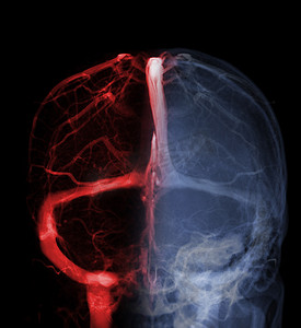 用于诊断脑静脉血栓形成的脑静脉造影术