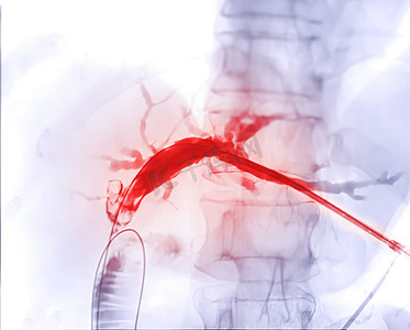 切除术摄影照片_医生在现代手术室内进行 ERCP 和腹腔镜胆囊切除术后门静脉的 X 射线图像。