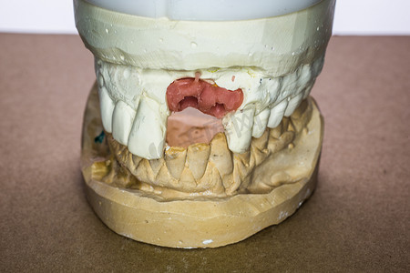 植入物摄影照片_带植入物的假牙