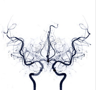 拱形贴标摄影照片_介入放射学中透视的脑血管造影图像显示脑动脉。
