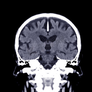 脑中风种类摄影照片_脑冠状视图的 CT 扫描用于诊断脑肿瘤、中风疾病和血管疾病。