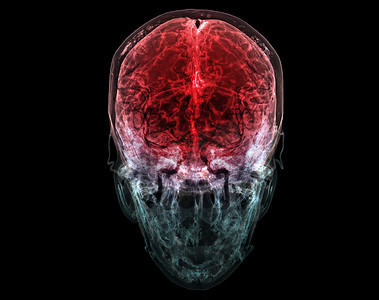 血型摄影照片_头部大脑动脉的 3D 渲染医学准确图示