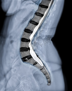 腰椎或 L-s 脊柱横向视图的 X 射线图像与 MRI l-s 脊柱的诊断腰痛。