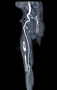 血管造影术摄影照片_CTA 股动脉从 MPR 曲线上流出，显示右股动脉用于诊断急性或慢性外周动脉疾病。