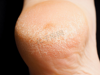 干裂的摄影照片_脚跟上干裂皮肤的特写，与黑色隔离