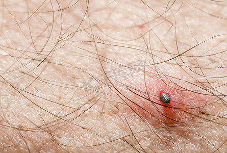 蜱虫附着在人的皮肤上