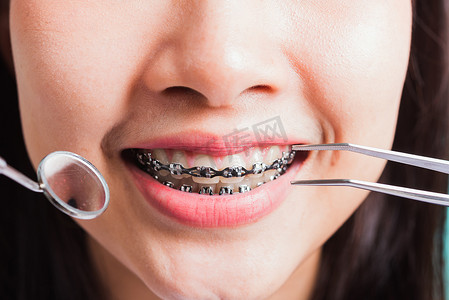 微笑的女人在牙齿上戴牙套笑着吃药
