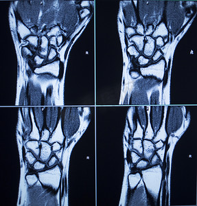 医疗十字光摄影照片_MRI 扫描测试结果手腕手部受伤