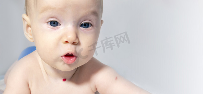 血液肿瘤摄影照片_一个脖子上有血管瘤的婴儿躺在白色背景上