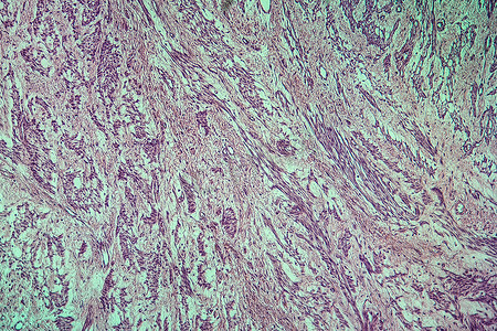 子宫病变组织的纤维肌瘤 100x