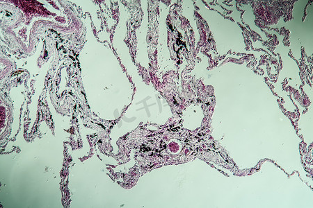 被石棉肺污染的组织 100x
