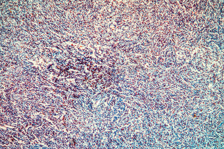 胆囊肿瘤摄影照片_100x 显微镜下的胆囊组织癌