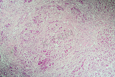 肝病变摄影照片_肝硬化病变组织在显微镜下 100x