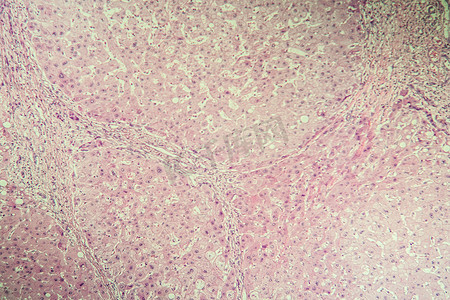 肝病变摄影照片_肝硬化病变组织在显微镜下 100x