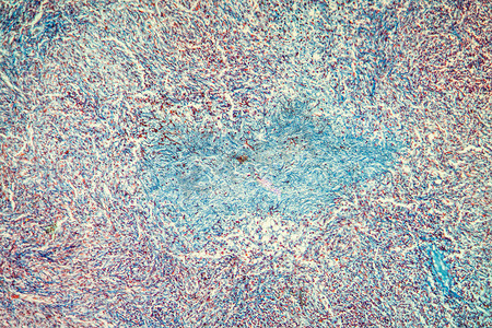 胆囊肿瘤摄影照片_100x 显微镜下的胆囊组织癌