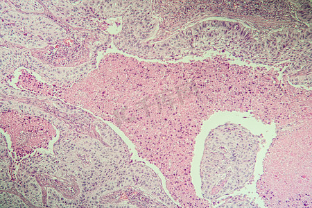 肝病变摄影照片_显微镜下鳞状细胞癌病变组织 100