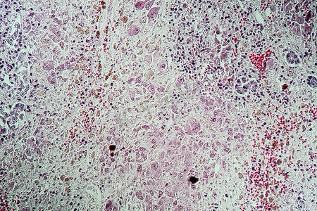 肝病变摄影照片_块茎叶蘑菇中毒后的病变肝组织
