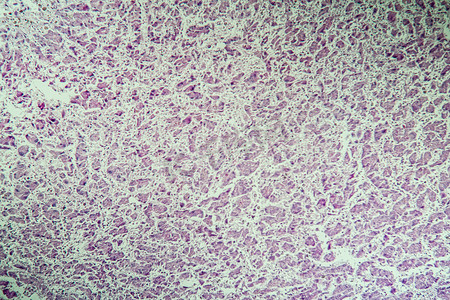 肝病变摄影照片_100x 显微镜下的肝癌病变组织