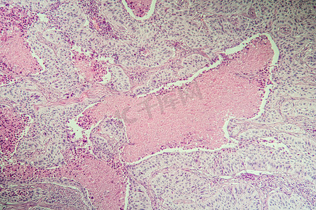 肝病变摄影照片_显微镜下鳞状细胞癌病变组织 100